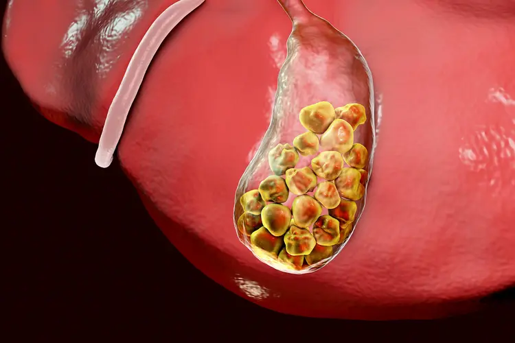 Gallbladder Surgery