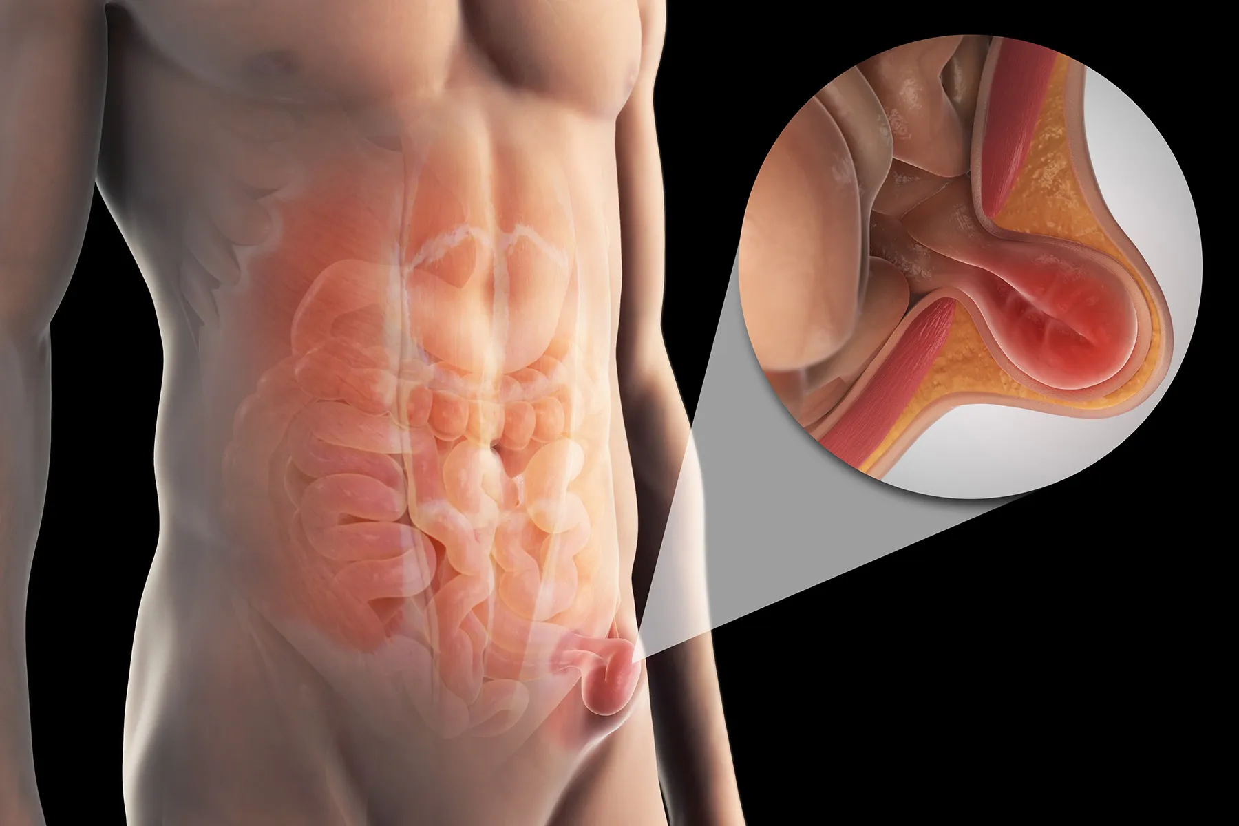 Hernia Surgery