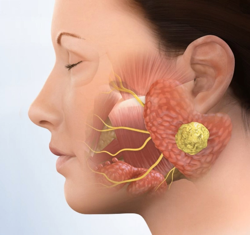 Salivary Gland Surgery