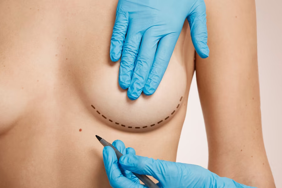 Breast Surgery
