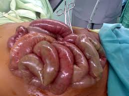 Stomach and Intestine Surgery